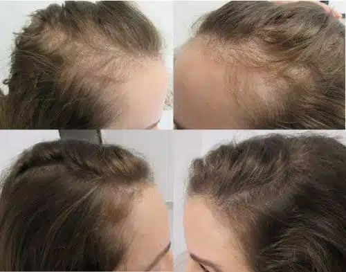 hair loss in women - woman with traction alopecia and stress-related hair loss 